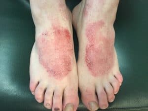 INTOTO anti-Fungtifungal